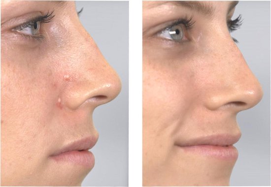 Derma Suction : nettoyage en profondeur de la peau et des pores, élimination des points noirs, appareil anti-points noirs, nettoyant pour le visage, électrique, nettoyeur de pores