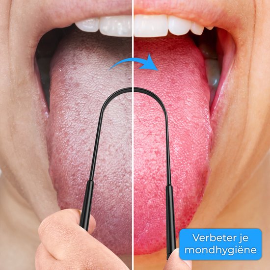 Grattoir à langue professionnel Nuvance - Kit 3 en 1 - pour l'hygiène bucco-dentaire - Nettoyeur de langue - Grattoir à langue - Tongue Scraper - Acier inoxydable - Noir