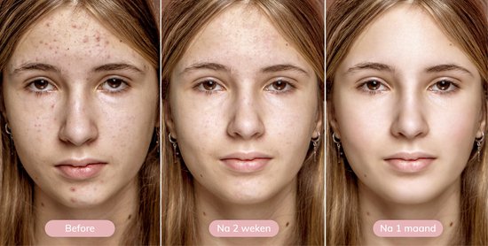 Vimora Élimination des points noirs - Nettoyant visage - Élimination des points noirs - Élimination des boutons - Nettoyant visage - Soins hommes et femmes - Acné et boutons - Set de soins du visage - Nettoyant pur