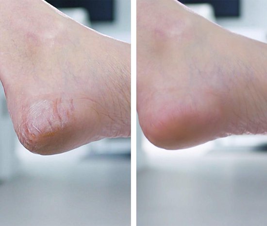 Pedi Vac - Lime à pieds électrique - 2 embouts
