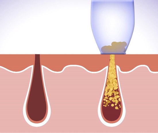Derma Suction : nettoyage en profondeur de la peau et des pores, élimination des points noirs, appareil anti-points noirs, nettoyant pour le visage, électrique, nettoyeur de pores