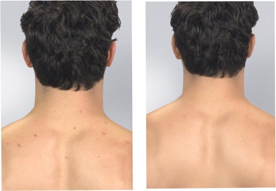 Derma Suction : nettoyage en profondeur de la peau et des pores, élimination des points noirs, appareil anti-points noirs, nettoyant pour le visage, électrique, nettoyeur de pores