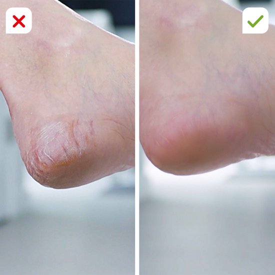 Pedi Vac - Lime à pieds électrique - 2 embouts